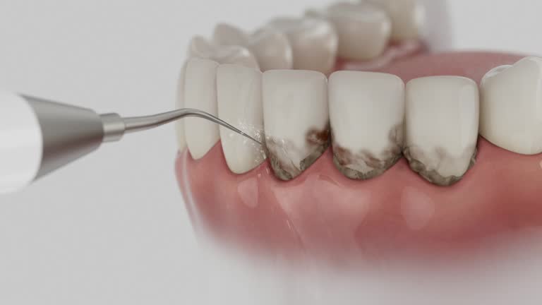 Trusted Wisdom Tooth Removal service in Redmond, WA - Dentist Open Now
